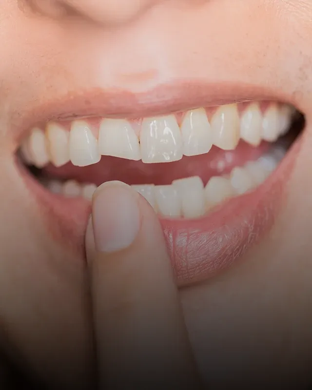 Emergency Dental Care Person With Broken Tooth
